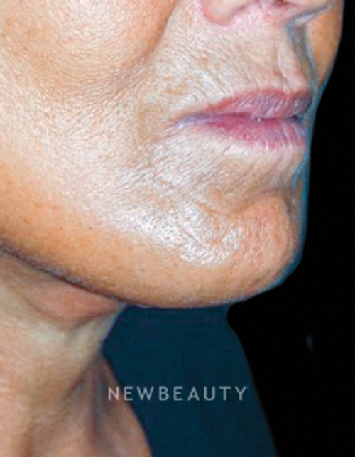 Dr. Roman Rayham - Facelift - After