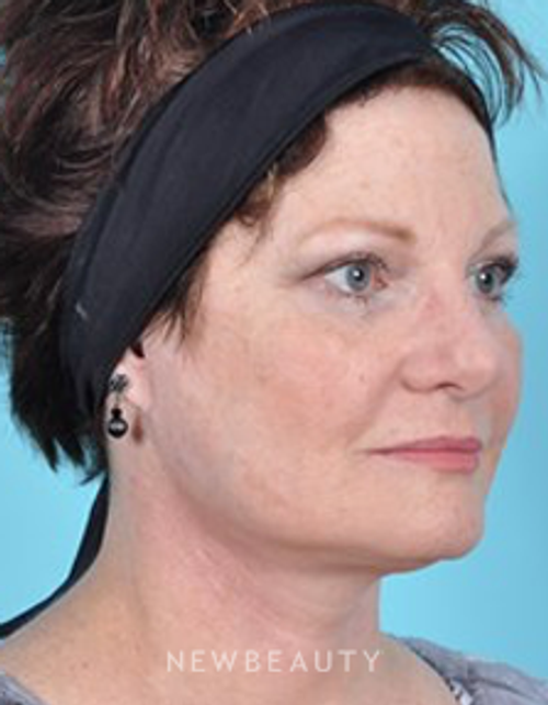 Dr. Brad Bengtson - Facelift - After