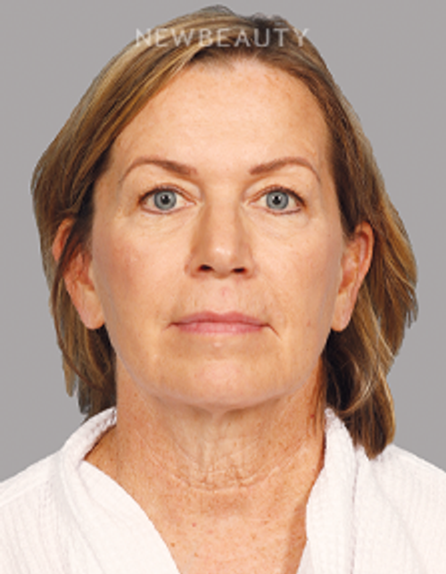 Dr. Mahabir – Upper Blepharoplasty – 20637850 - Before