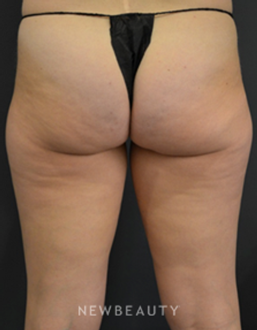 Dr. Aviva Preminger - CoolSculpting - Before