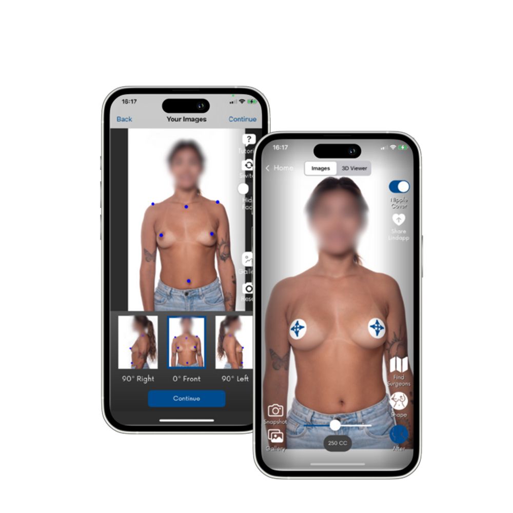 Mentor’s Breast Implant Simulator