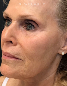 Dr. Janet Allenby - ThermiTight - Before