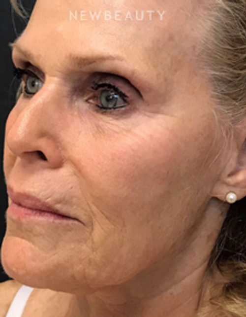 Dr. Janet Allenby - ThermiTight - Before