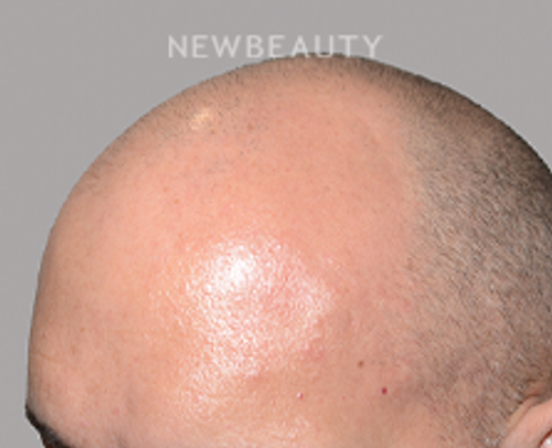 Dr. Jeffrey Epstein - Hair Transplant - 46167961 - Before