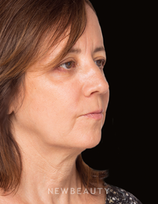 Dr. Janet Allenby - The “Liquid Lift” - Before