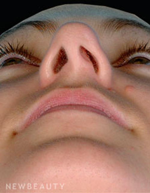 Dr. David Kim Rhinoplasty - Before