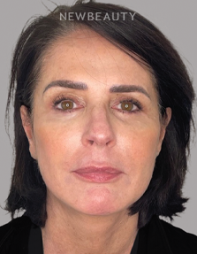Dr. Dilip Madnani - Facelift -  45284120 - After