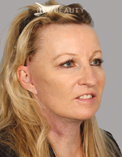 Dr. Mahabir - Facelift - 20637984 - After