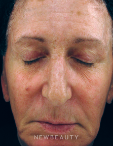 Dr. Kenneth Beer IPL Laser - After