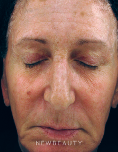 Dr. Kenneth Beer IPL Laser - After