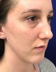 Dr. Dilip Madnani - Lower Blepharoplasty - Before