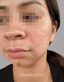 Dr. Anna Chacon - Rosacea / Acne - 34284767 - Before