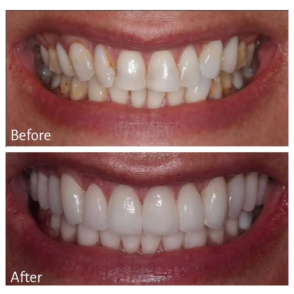 Treatment: Porcelain Restorations, Crowns, Veneers, Implants and Gum Recontouring