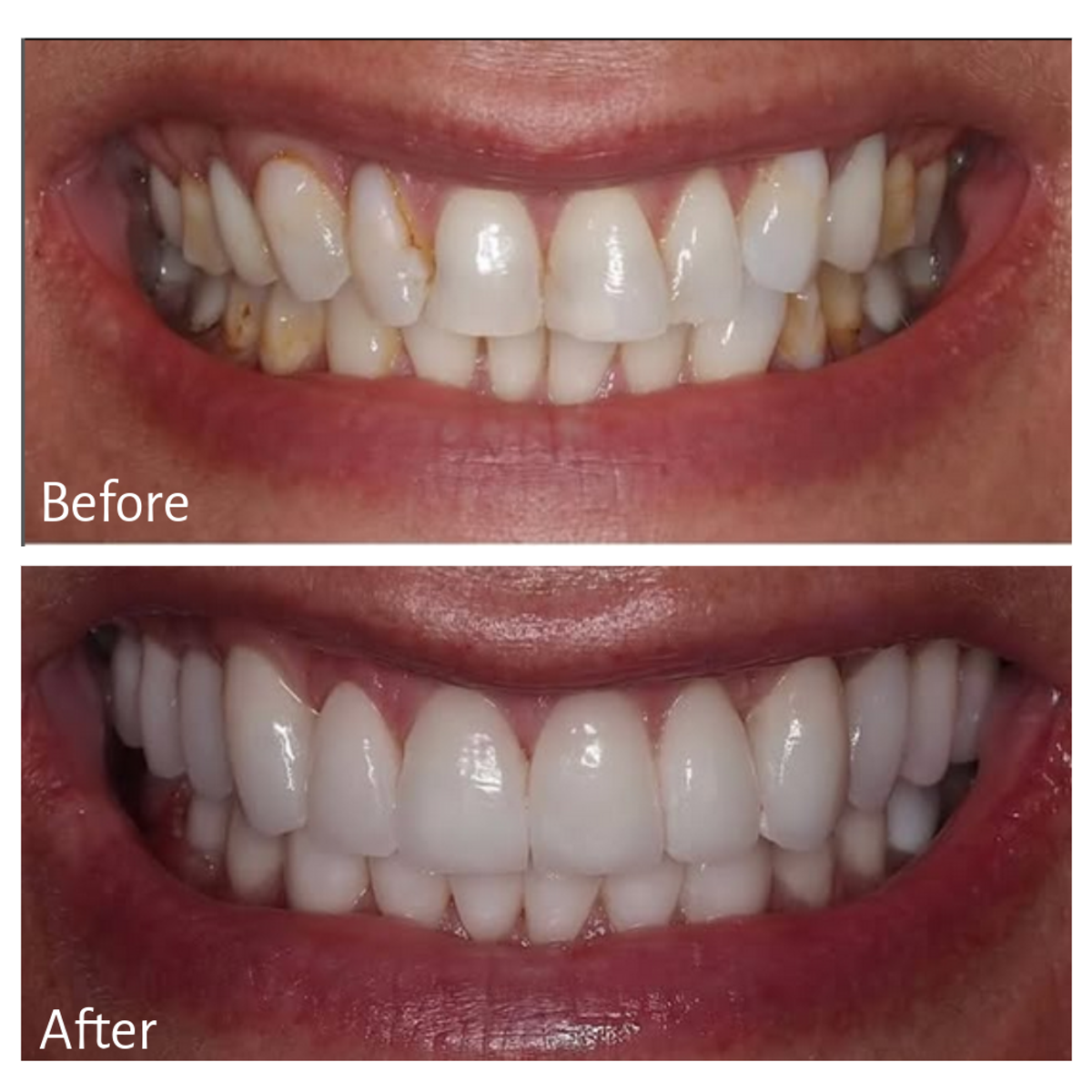 Treatment: Porcelain Restorations, Crowns, Veneers, Implants and Gum Recontouring