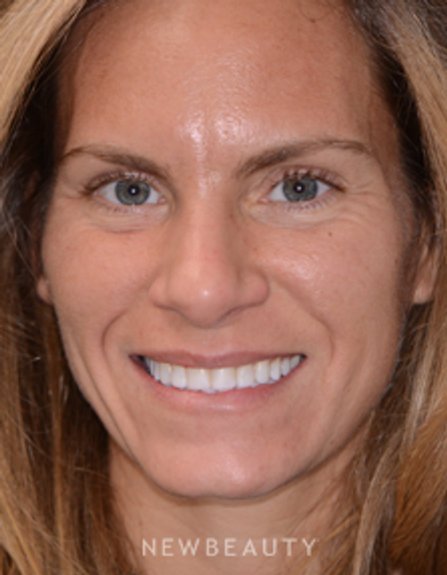 Dr. Irene Grafman - Smile Makeover - After