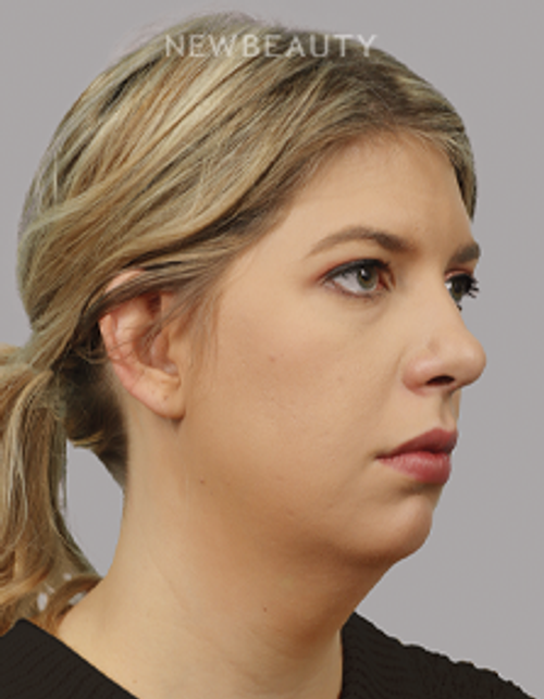 Dr. Michael McNeel - Profile Refinement - 44726153 - Before