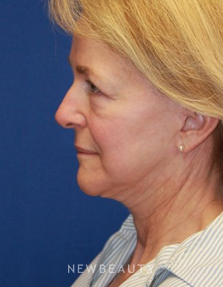 Dr. Dillip D. Madnani - Necklift - Before