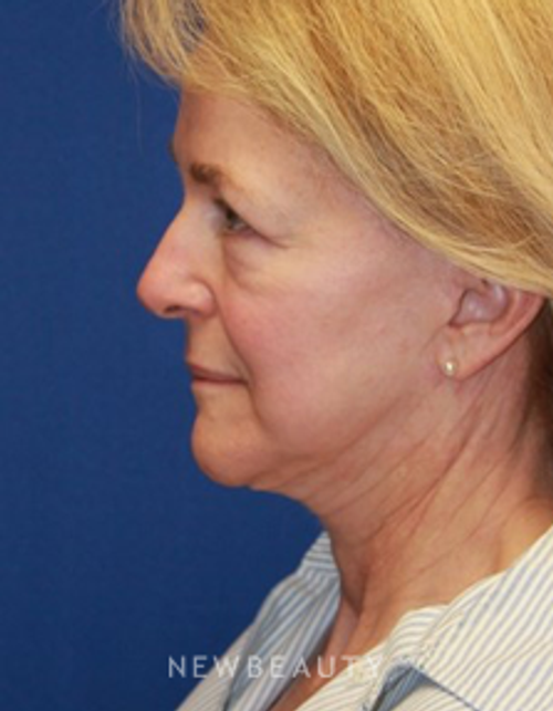 Dr. Dillip D. Madnani - Necklift - Before