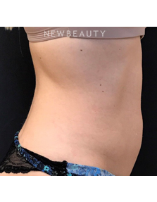 Dr. Janet Allenby - EmSculpt - Before