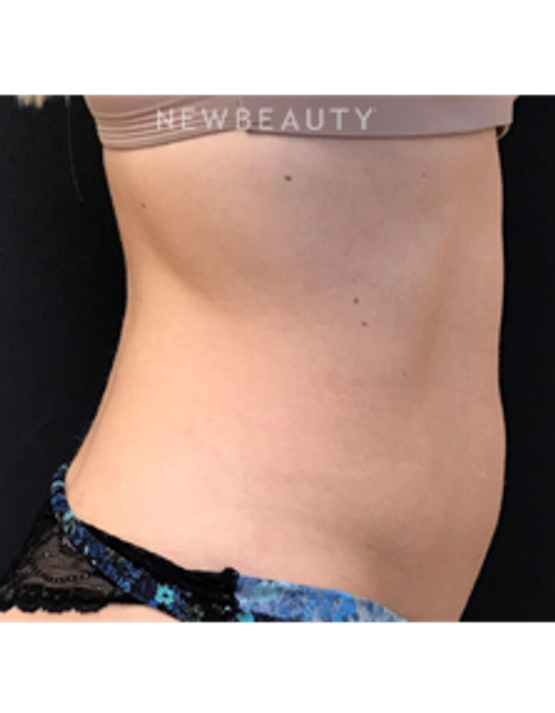 Dr. Janet Allenby - EmSculpt - Before