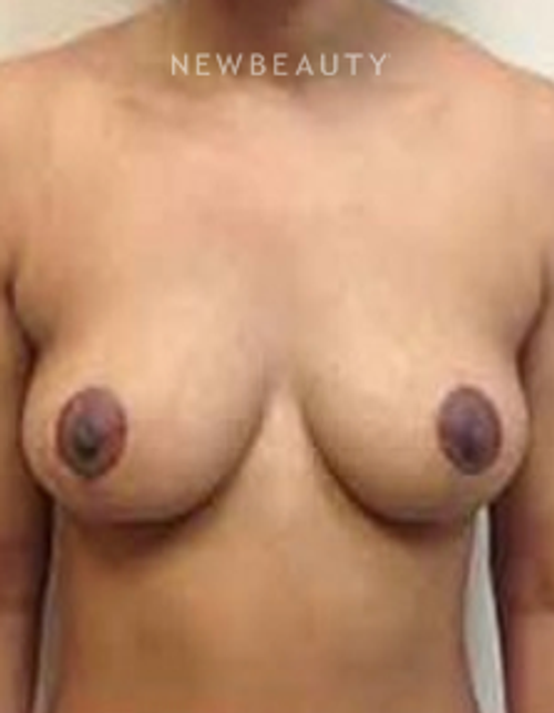Dr. B. Aviva Preminger - Breast Lift - After