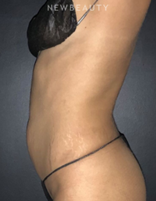 Dr. Janet Allenby - CoolTone - After