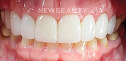 Dr. Sonya L. Wintzell - Vibrant Smile Design - 33124538 - After