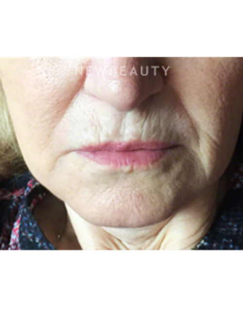 Dr. Kally Papantoniou - Injectables and Fillers - Before