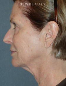 Dr. Min S. Ahn - Necklift - Before