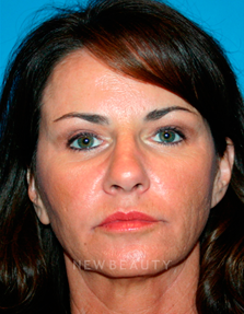 Dr. Kelly Bomer Liquid Facelift - After