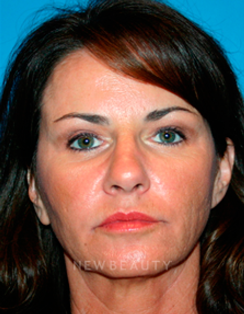 Dr. Kelly Bomer Liquid Facelift - After