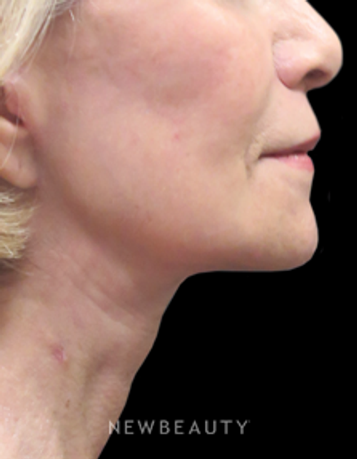 Dr. Elie Levine - Liposuction - After