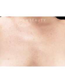 Dr. Julie Russak - Lasers - After