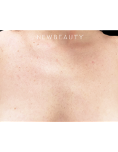 Dr. Julie Russak - Lasers - After