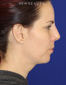 Dr. Dilip Madnani - Restylane - After