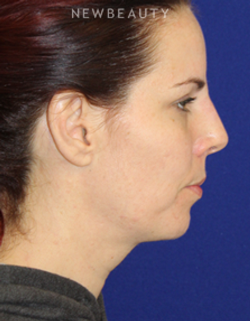 Dr. Dilip Madnani - Restylane - After