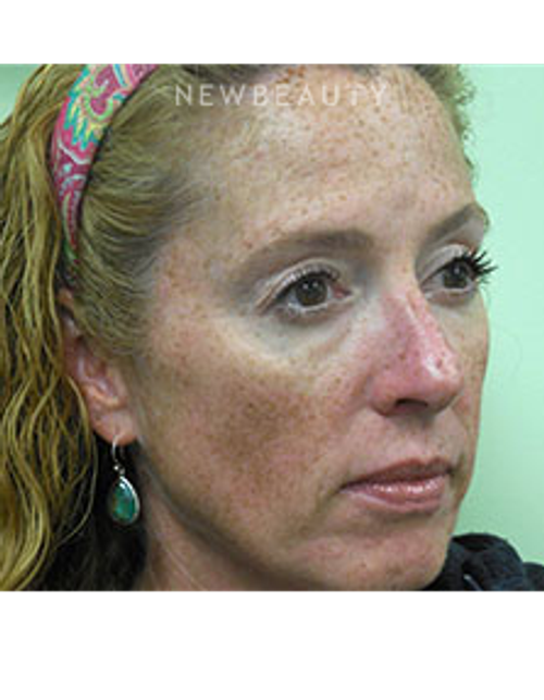 Dr. Christine Hamori - Reversing Sun Damage - Before