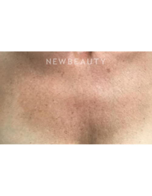 Dr. Marina Peredo - Ulthera - After