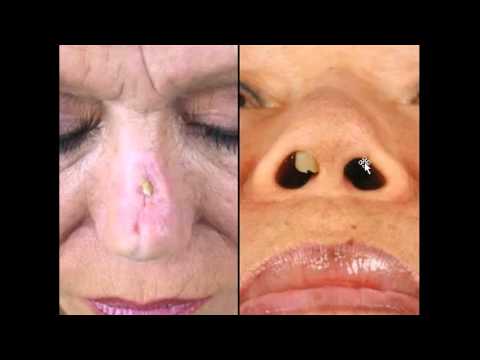 Dr. David Kim – Artificial Implants In Rhinoplasty