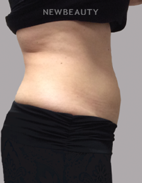 Dr. Linda Honet - Coolsculpting - 15045111 - After