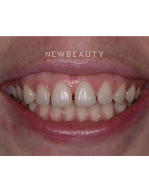 Dr. Irene Grafman - Gum Lift - Before