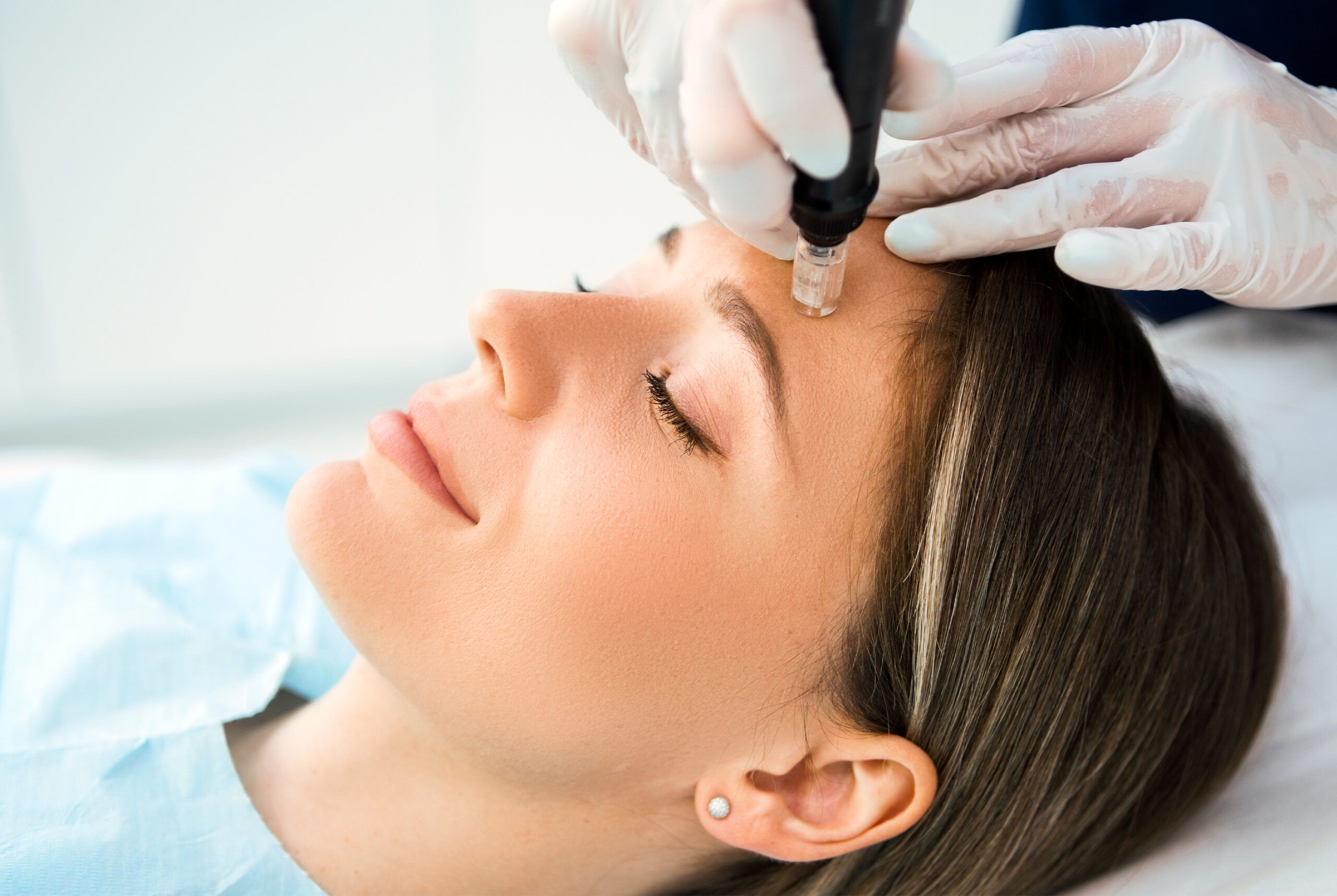 woman getting microneedling treatment
