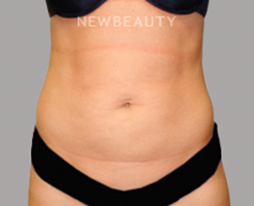 Dr. Sanjay Grover - Liposuction - 49728164 - Before