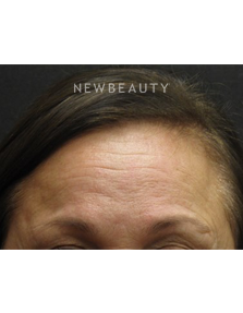 Dr. Jody Levine - Lasers - Before