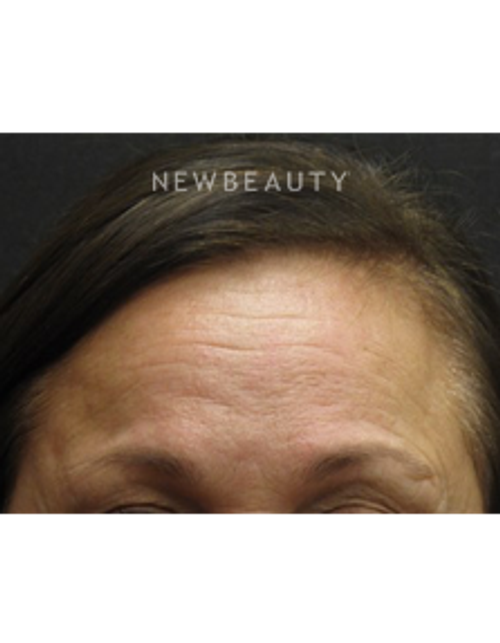 Dr. Jody Levine - Lasers - Before