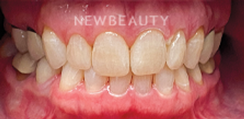 Dr. Sonya L. Wintzell - Vibrant Smile Design - 33124538 - Before