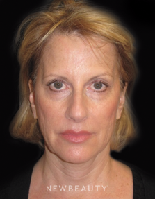 Dr. Janet Allenby Injectables & Fillers - Before