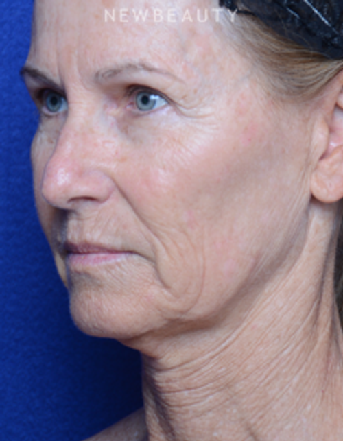 Dr. Alan Durkin - Facelift - Before
