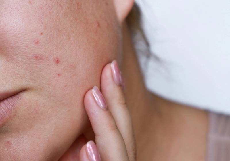 winter acne