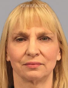 DR. AMY M. SPROLE - Facial Rejuvenation - 46920209 - Before